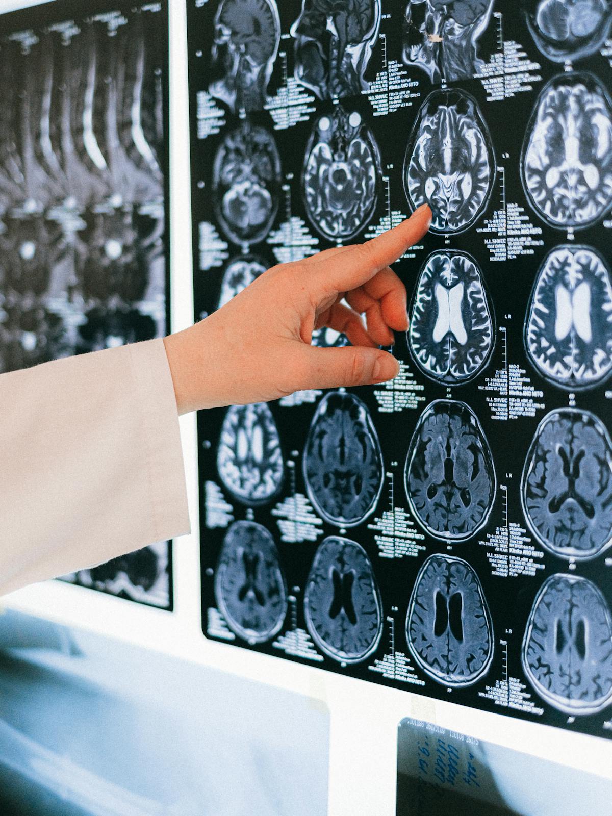 Consulta educativa sobre nutricion, sintomas y manejo global del lipedema.